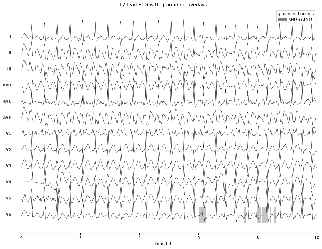 ECG digitized from a photograph of a paper ECG, with saliency overlays