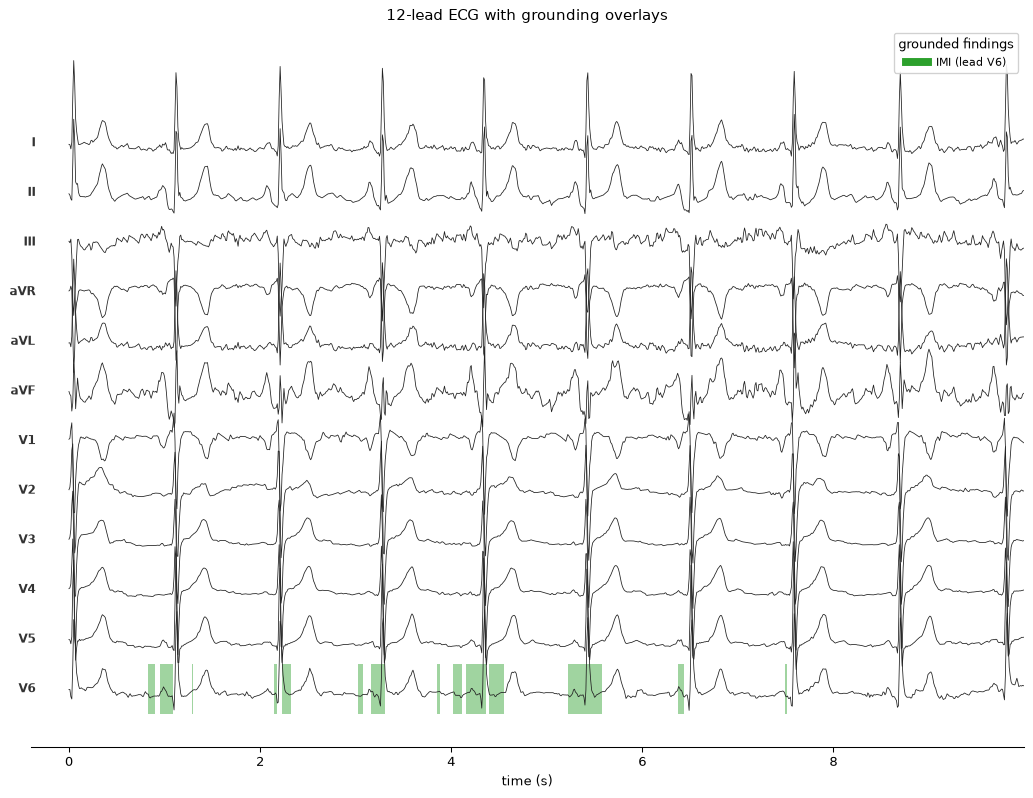 12-lead ECG with per-finding saliency overlays highlighting inferior leads II, III and aVF